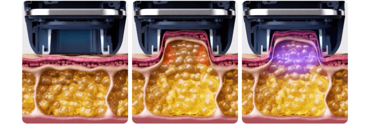 HOMEMODE - Therma Lift Beauty Device (+3 Skin Booster Ampoules)