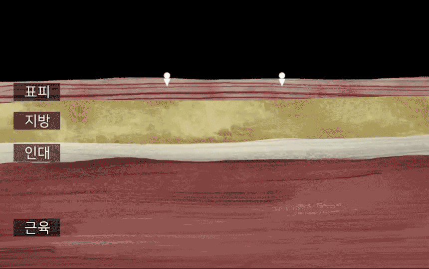 BEAUND - Leg Thin Beauty Device