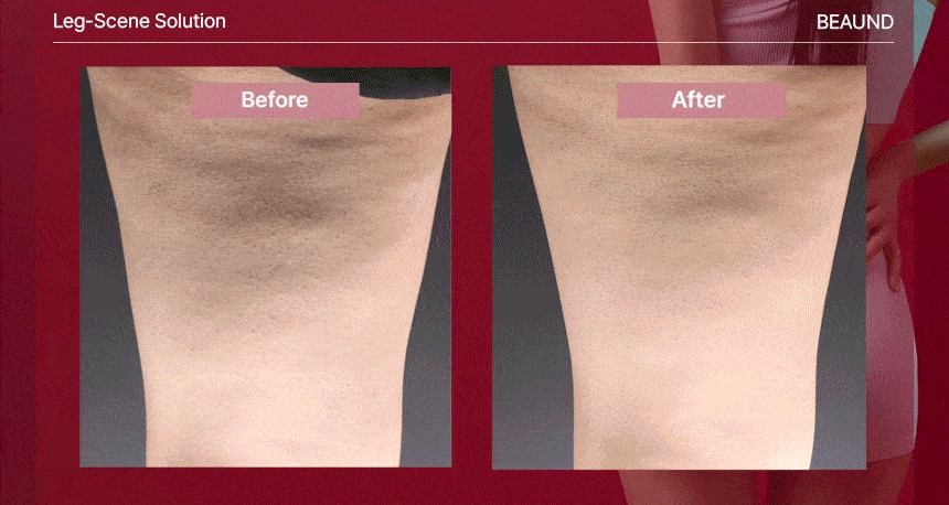 BEAUND - Leg Thin Beauty Device