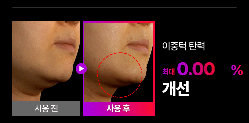 MOMMYCARE - EMS V-THERA Lifting Beauty Device (Teenieping Edition)