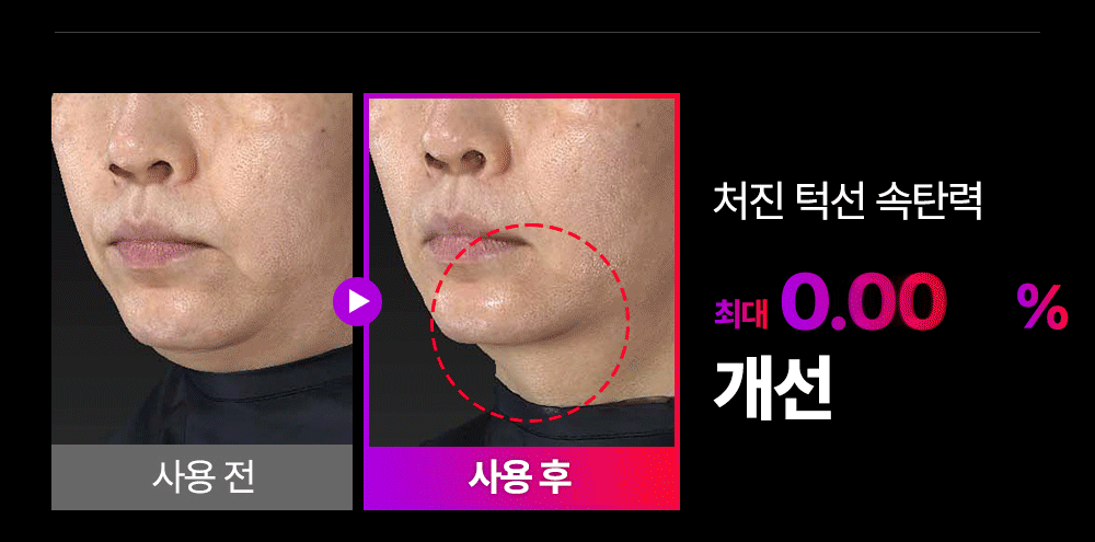 MOMMYCARE - EMS V-THERA Lifting Beauty Device (Teenieping Edition)