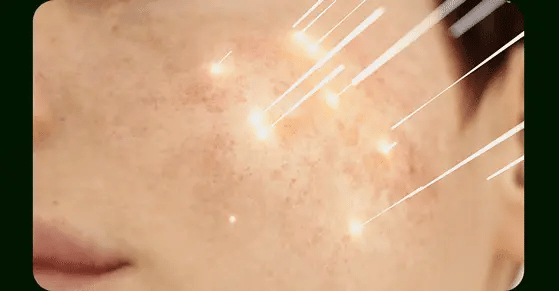 VUDE - Ultra-Low Molecular Diva Shot (Pore Care Beauty Device)