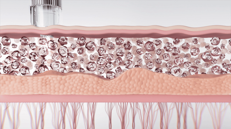 INJECTIER - Auto MTS Dual Ampoule Tip Inject Shot