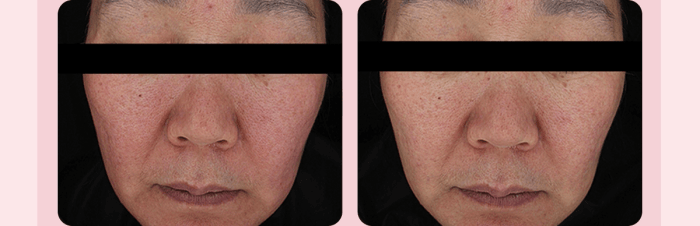 MEDICUBE AGE-R BOOSTER V ROLLER (BEAUTY DEVICE)