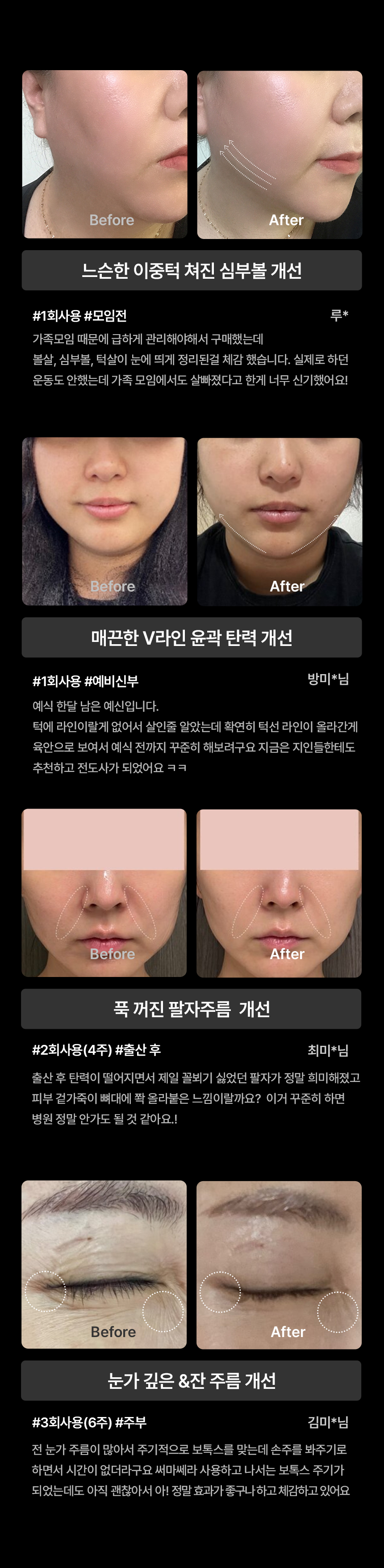 THERMATHERA - Unlimited-Shot HIFU Beauty Device [New Launch!]