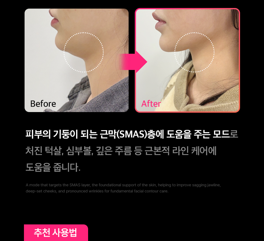 THERMATHERA - Unlimited-Shot HIFU Beauty Device [New Launch!]