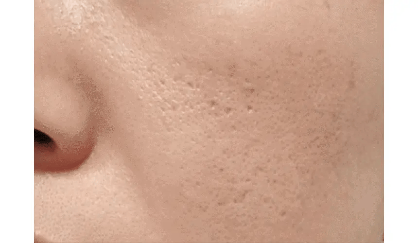 VUDE - Ultra-Low Molecular Diva Shot (Pore Care Beauty Device)